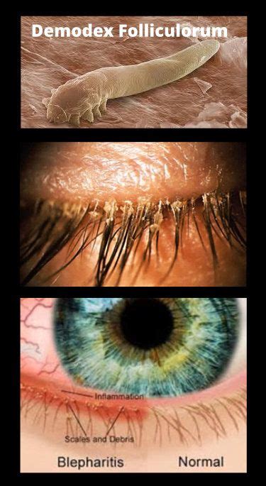 Demodex Blepharitis - Eye Care Solutions | Blepharitis, Demodex, Eye mites