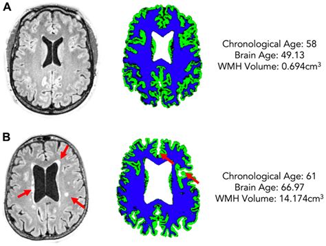 White matter hyperintensity load is associated with premature brain aging - Figure f2 | Aging