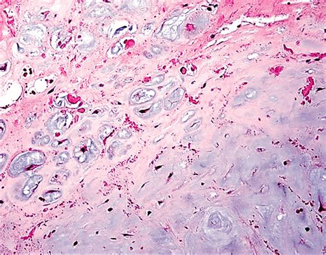 Pathology Outlines - Chondrosarcoma (primary, secondary, periosteal)