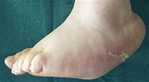 Charcot Foot Treatment in Pune | Dr. Chetan Oswal