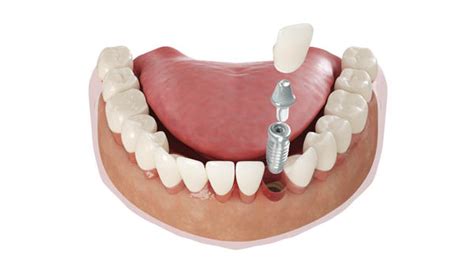 Do Dental Implants Look and Feel Natural? - Lasting Impressions Dental Group Houston TX