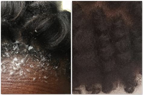 Dandruff Vs Dry Scalp: What Is The Difference & What Can You Do About It - Black Hair Information