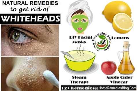 How to Get Rid of Whiteheads Fast - 14 Natural Ways - Home Remedies Blog