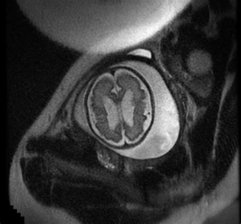 Hydrocephalus MRI - wikidoc
