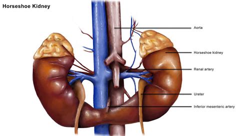 Horseshoe kidney causes, symptoms, complications, diagnosis & treatment