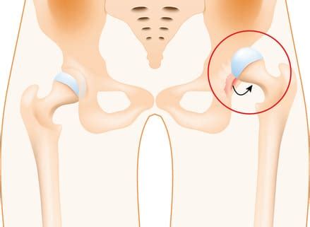 Hip Dislocation - Colorado Center of Orthopaedic Excellence