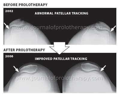 X-rays Document Cartilage Regeneration in Knees After Prolotherapy ...