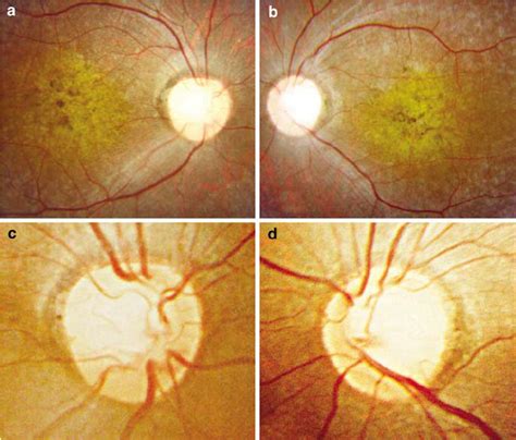 Fundus retinography showing bull’s eye maculopathy in (a) right eye and... | Download Scientific ...