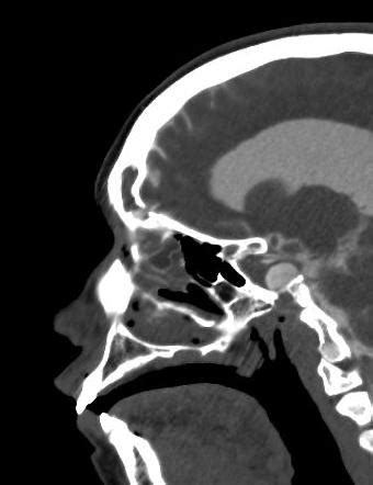 CSF rhinorrhea | Radiology Case | Radiopaedia.org