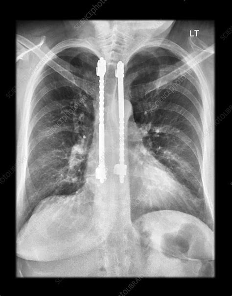 Thoracic Harrington Rods on Chest X-Ray - Stock Image - C043/0305 ...