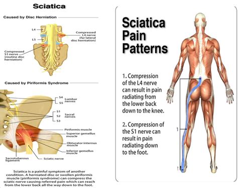 Sciatica in Econdido, CA | Heilman Chiropractic and Spinal Decompression