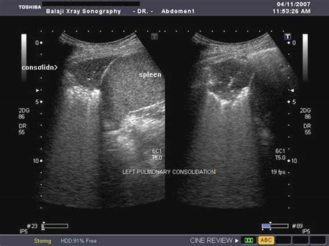 A Gallery of High-Resolution, Ultrasound, Color Doppler & 3D Images - Chest