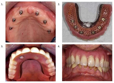 Implant Supported Dentures Maxillary