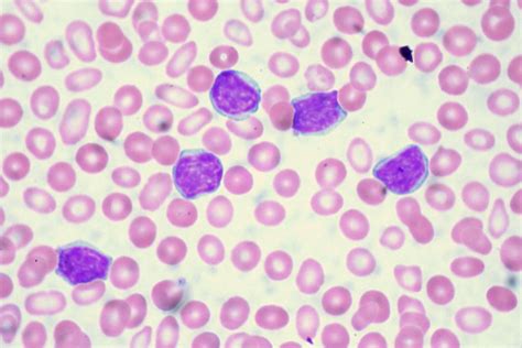 Chronic Lymphocytic Leukemia | Peripheral blood film from a … | Flickr