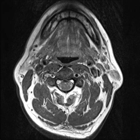 Papillary thyroid cancer MRI - wikidoc