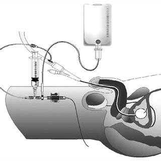 (PDF) Can Selection of Mechanical Ventilation Mode Prevent Increased Intra-Abdominal Pressure in ...