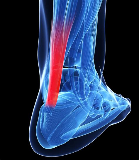 Physical Therapist's Guide to Peroneal Tendinopathy