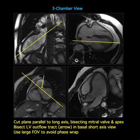 Pseudo 2 & 4-Chamber Views Short Axis View 4-Chamber View Left 2-Chamber View 3-Chamber View ...