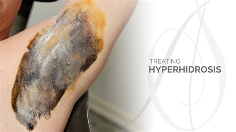 Treating Hyperhidrosis - YouTube