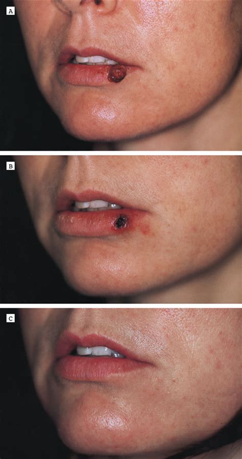 The Combined Continuous-Wave/Pulsed Carbon Dioxide Laser for Treatment ...