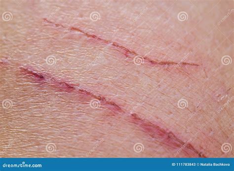 Shallow Inflamed Scratches on Human Skin Stock Image - Image of danger, inflamed: 111783843