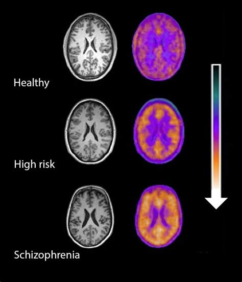 Inflammation in the Brain Linked to Schizophrenia Risk - Neuroscience News