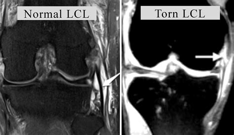 LCL Treatment in Chennai | LCL Tear Treatment Cost in Chennai