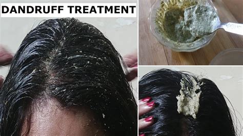 Remove Dandruff Permanently in 1 Day - Dandruff treatment at home for Hair Growth & long hair ...