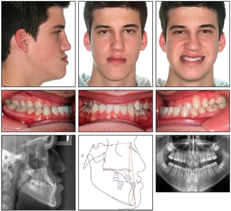 Skeletal Malocclusion