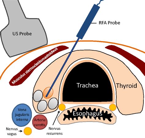 Thyroid RFA vs. Conventional Thyroidectomy