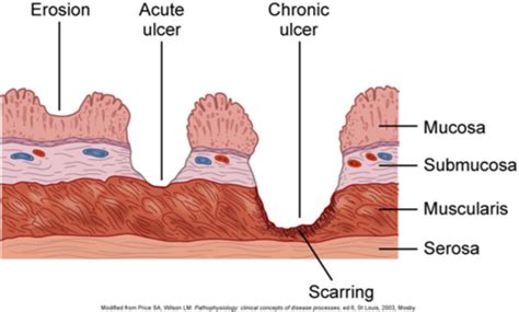 peptic ulcer disease Flashcards | Quizlet