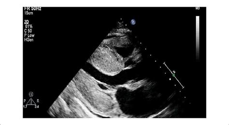 Echo Clues: When to Suspect Amyloidosis - Cardiac Wire