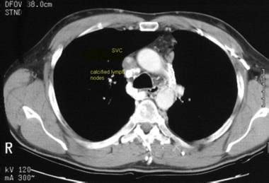 Superior Vena Cava Syndrome (SVCS) Workup: Imaging Studies, Procedures