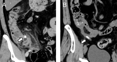 Fecalith in the Proximal Area of the Appendix is a Predictor of Failure of Nonoperative ...