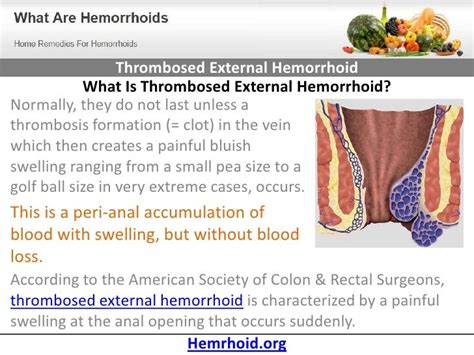 Thrombosed External Hemorrhoid Pictures / Internal & External Hemorrhoids: Top Causes & Symptoms ...