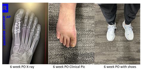 My Lapiplasty® Big Toe Joint Fusion™ Journey: Weeks 4-7 | Foot & Ankle ...