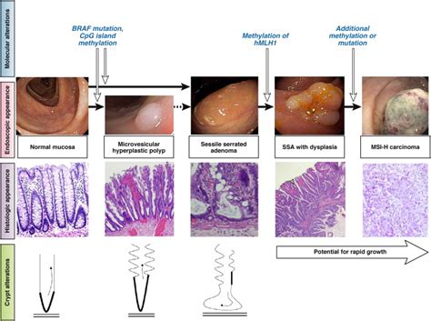 Sessile Serrated Adenomas: An Evidence-Based Guide to Management - Clinical Gastroenterology and ...