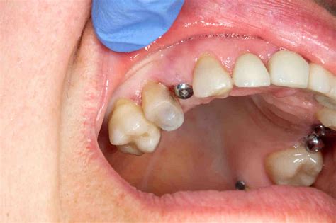 How long does swelling last after dental implant - Dental News Network