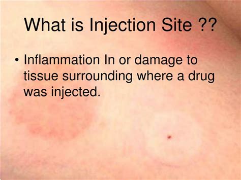 PPT - Injection Site Reaction PowerPoint Presentation, free download - ID:3111753