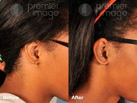 Earlobe Repair Before and after photos | Sandy Springs, GA | Patient 15795