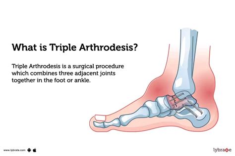 Triple Arthrodesis: Purpose, Procedure, Benefits and Side Effects