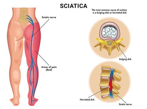 Sciatica Exercises: What's Best and What to Avoid - NJ's Top Orthopedic Spine & Pain Management ...