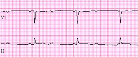 Accelerated Junctional Rhythm