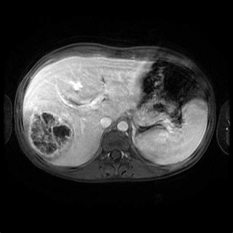 Radiology Cases: Pyogenic Liver Abscess