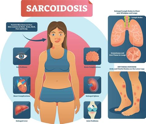 Sarcoidosis - Private Sarcoidosis - Treatment Respiratory London