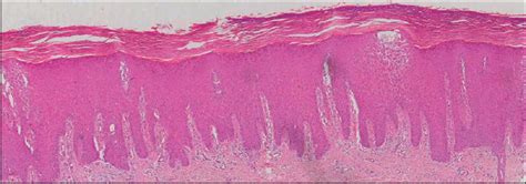 A study of the histopathology of palmo-plantar psoriasis and hyperkeratotic palmo-plantar ...