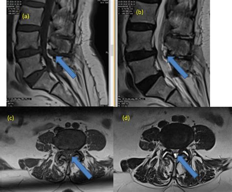 Ligamentum Flavum Cyst With Acute Onset Motor Deficit: A Literature Review and Case Series ...