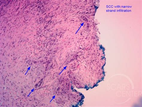 Forehead SCC with Perineural Invasion - Skin Cancer and Reconstructive ...