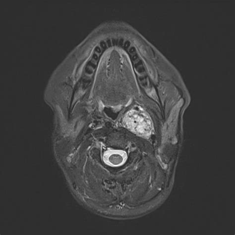 Sympathetic paraganglioma | Radiology Case | Radiopaedia.org | Radiology, Head and neck, Neurology