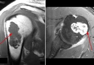 Enchondroma - OrthoInfo - AAOS